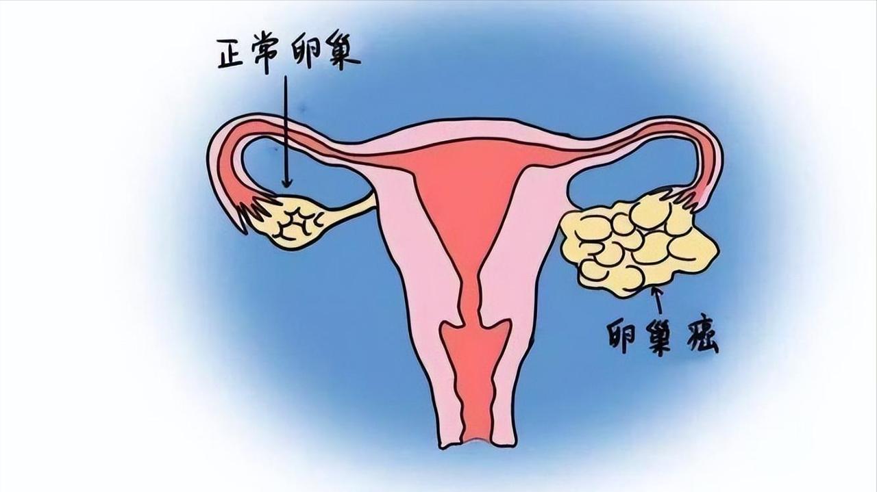 生活不节制，癌症找上门！45岁阿姨卵巢癌晚期，平时总爱做这些！现在很多人都觉