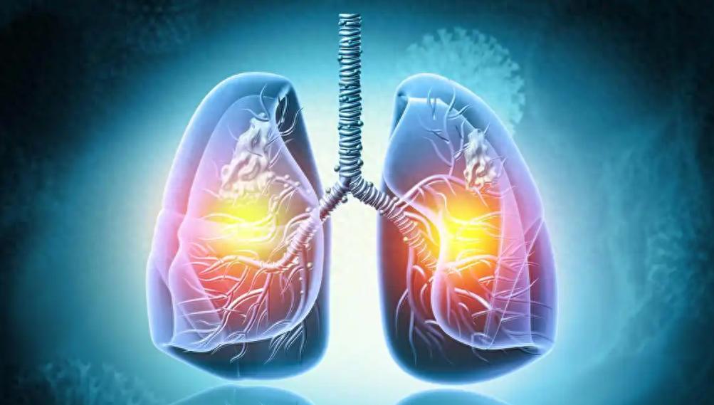 想要身体强，补肺少不了！4个经典方，给肺脏加个“金钟罩”作品声明：个人观点