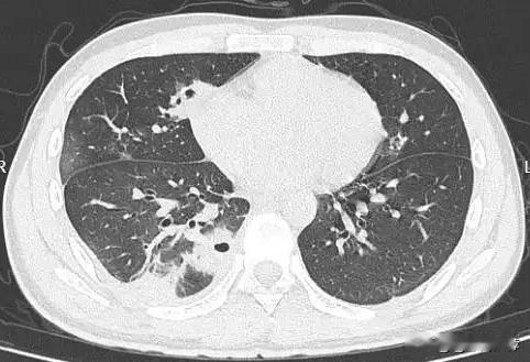 20岁男生挤痘险丧命！面部“危险三角区”为何如此危险？近日，一则医疗案例引发