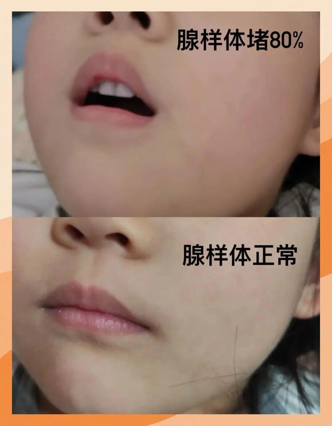 孩子腺样体肥大，为什么有的医生让戒荤？真的有科学依据吗？“主任，我们之前找老