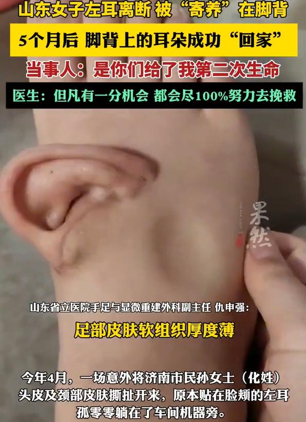 天下之大无奇不有！山东一女子因为意外，导致左耳断裂，送医后，医生竟然将耳朵“寄养