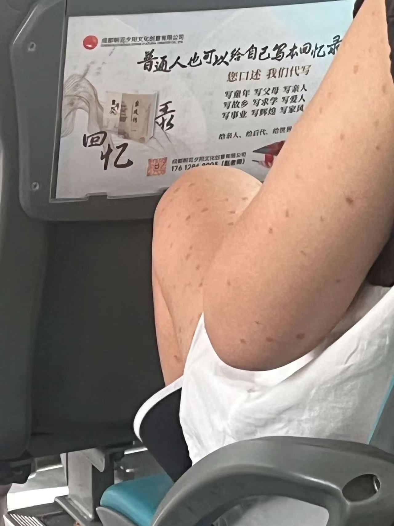 前面这位是让蚊子咬的嘛？