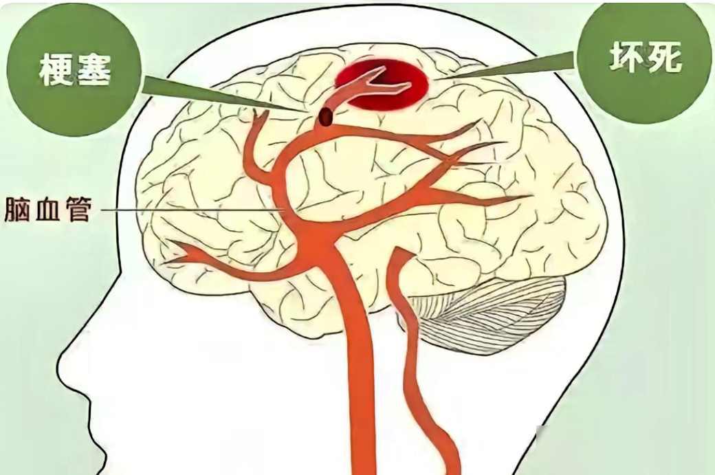 50岁以上的中老年人，脑梗就爱找上这样的你我爸上周在牌桌前手麻了，送去医院