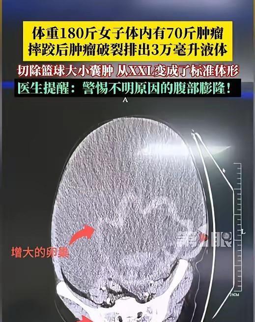 5月12日据红星新闻报道，浙江一女子身高不到一米六，180斤的体重通过各种手段都
