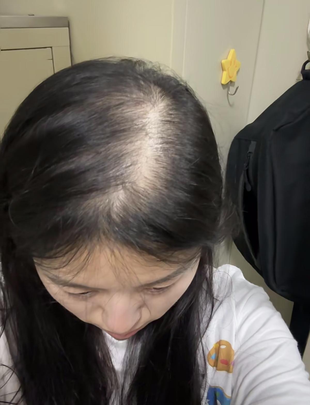 年轻人不要再熬夜伤发了！熬夜毁容还秃顶？近日，多家医学机构研究表明，熬夜可导