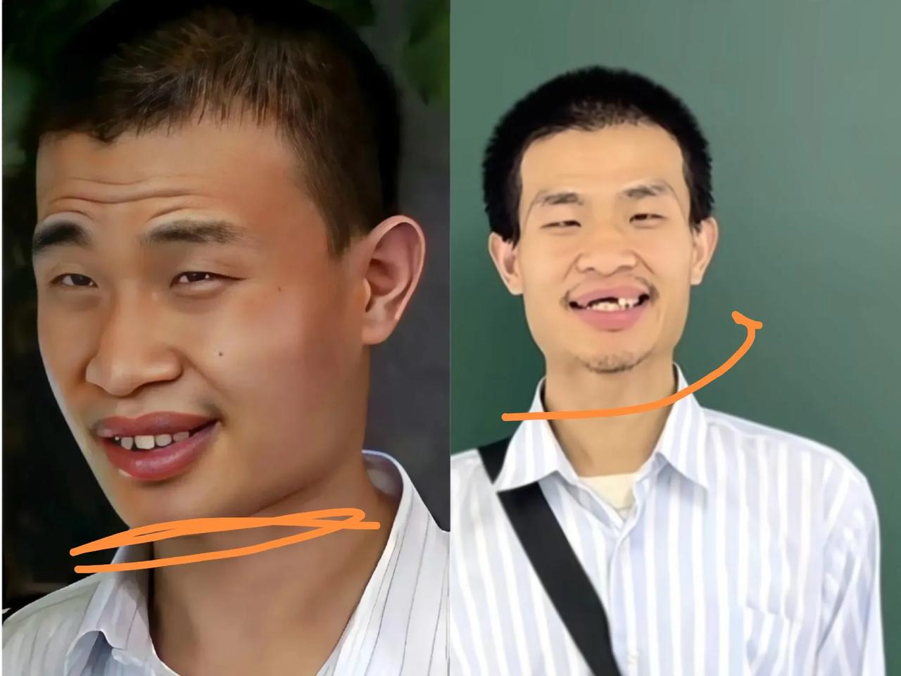 韦东奕在高考前一天现身，大家发现他的牙齿掉了好几颗，其实前几年他的牙齿还好好的。