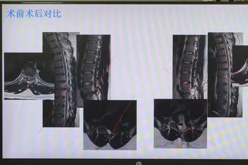 一觉醒来30岁男子双下肢瘫痪、大小便失禁，只因为前一晚体重两百多斤的他，为了