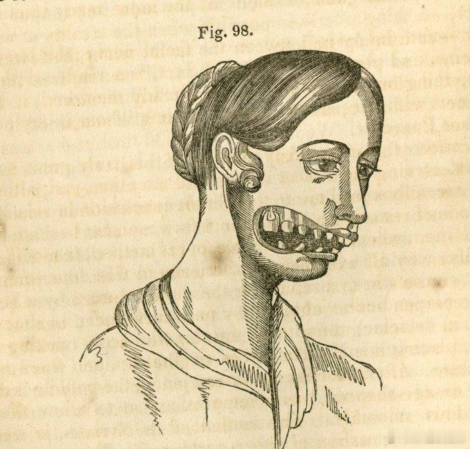 1903 - 腐烂下巴的火柴少女们，伦敦 🇬🇧  看看这些年轻女工...