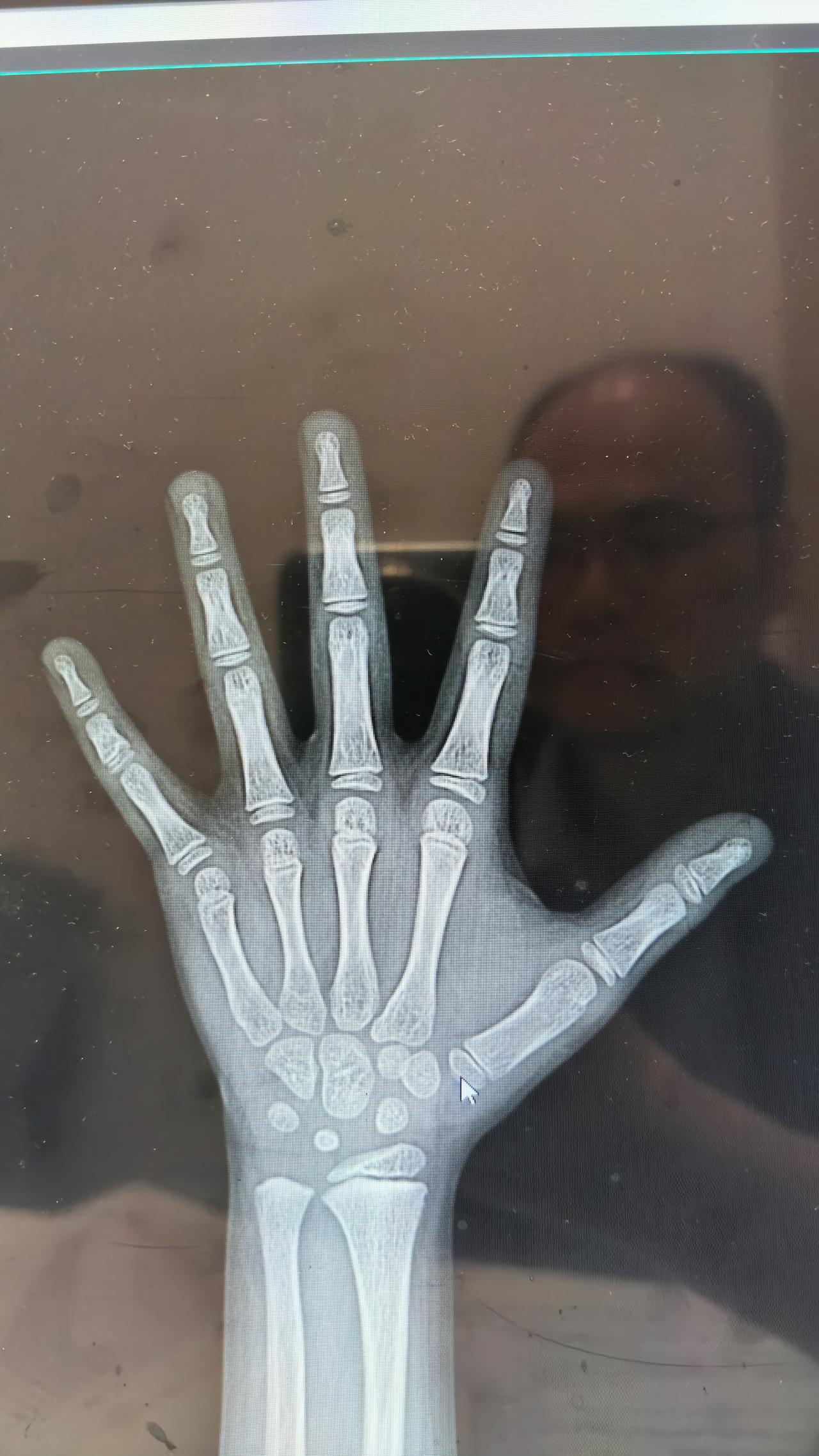 遗传不行就该认命吗？不是这样子的。分享一个案例，成功的案例。父亲身高160，母亲