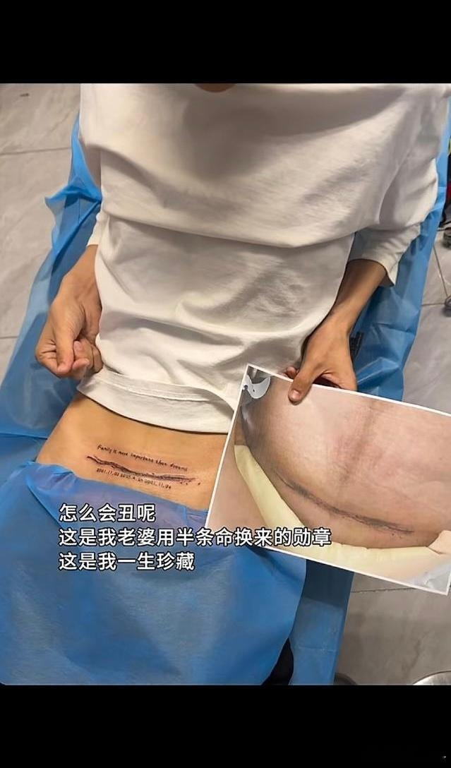 一个女生生育后肚子上留下了剖宫产的疤，然后她老公怕她伤心，也纹了一个，然后网友们