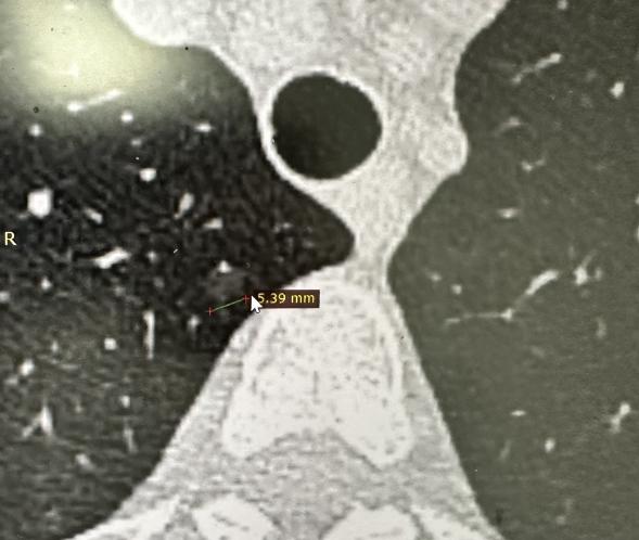 检查报告上出现“磨玻璃结节”这几个字，很多人第一反应就是担忧。但其实，并不是