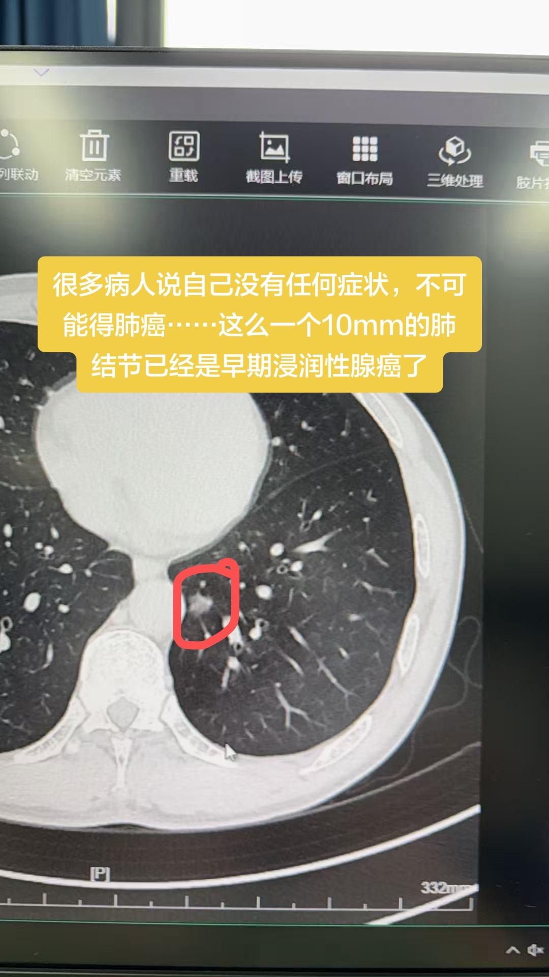 早期肺癌一般不会有任何症状，如果一个肺癌真的有咳血，胸痛等症状，大概率...