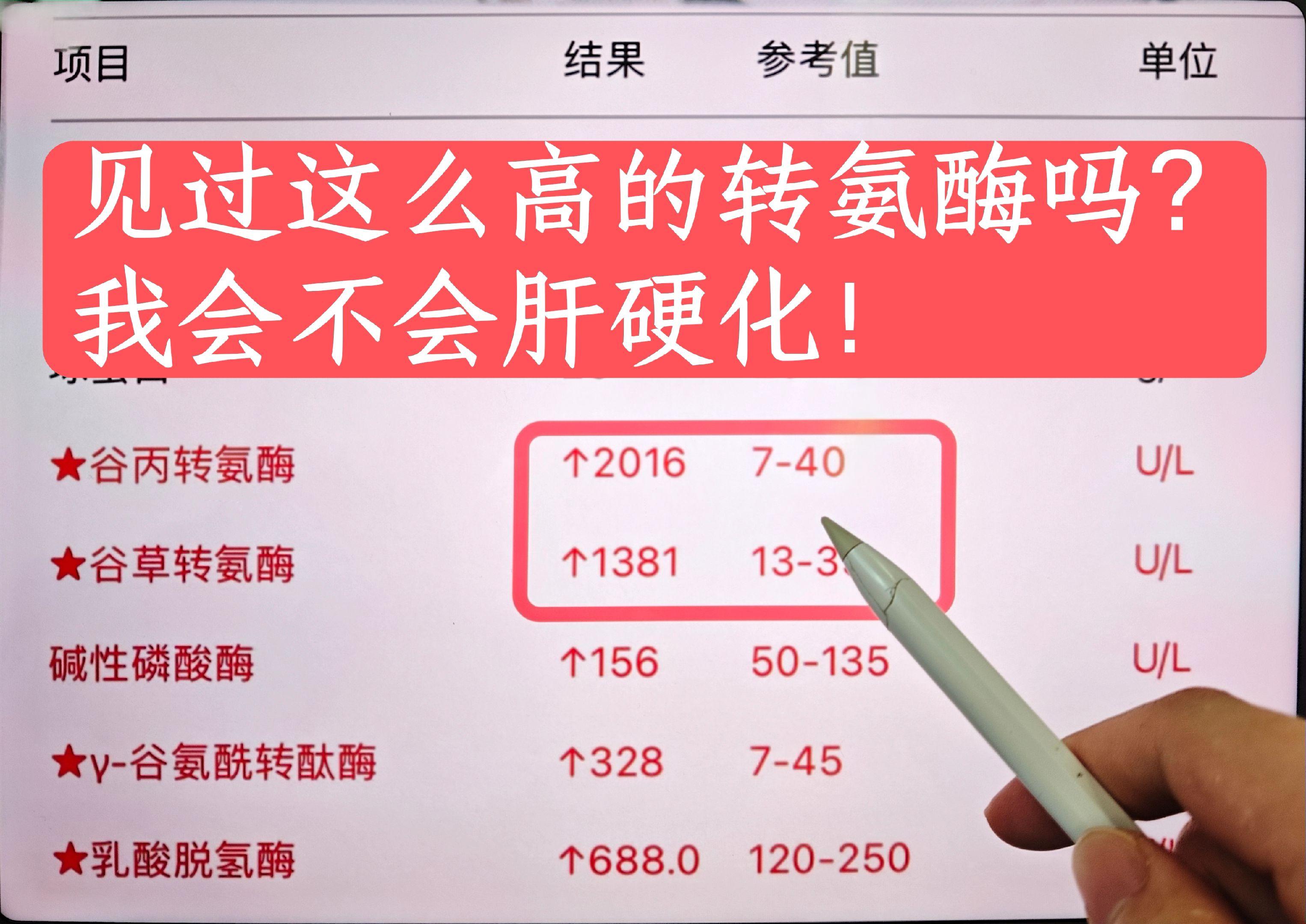我接诊一位患者，转氨酶升到2000多，很担心是进展到了肝硬化阶段，今年...