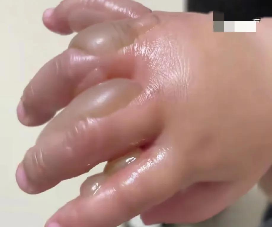 张纪中才9个月的小女儿手被保姆给烫的满手都是大水泡，隔着屏幕看都觉得手好痛。起
