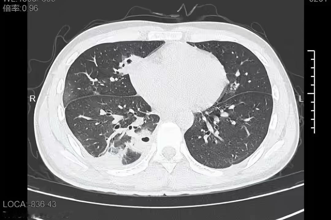真的惊到我了！一个20岁的小伙子，就因为挤了颗脸上的痘痘，直接把自己送进医院，肺
