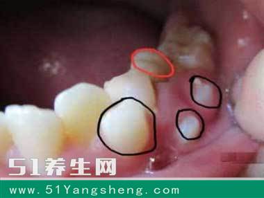 孩子换牙请务必重视这几点, 影响孩子一生!