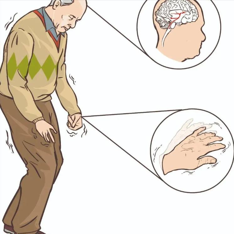 偏瘫为什么腿能走路了，胳膊还是不听使唤？今天把原因说清楚很多脑卒中患者都有这