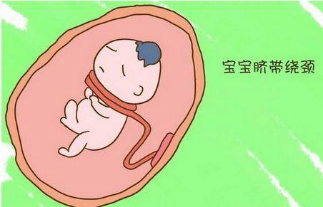 孕妈吗来听听医生关于脐带绕颈能否顺产是怎么说的!