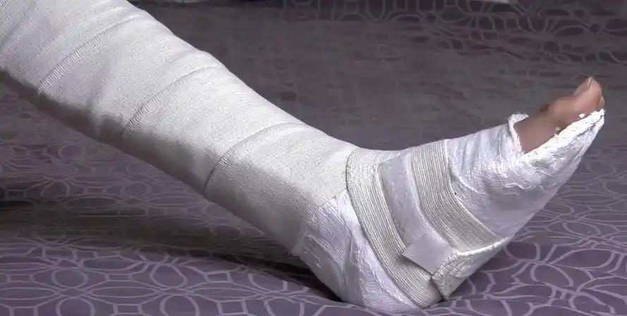 上海，女子出门时不慎从楼梯上摔倒，导致右腿粉碎性骨折，女子是公交司机，腿就是饭碗