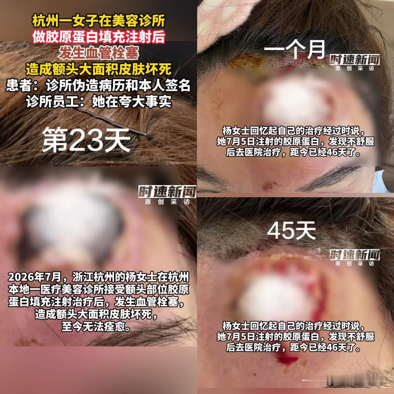 很多人觉得医美打针就是简简单单变美，看完这件事，真的让人后背发凉。杭州的杨