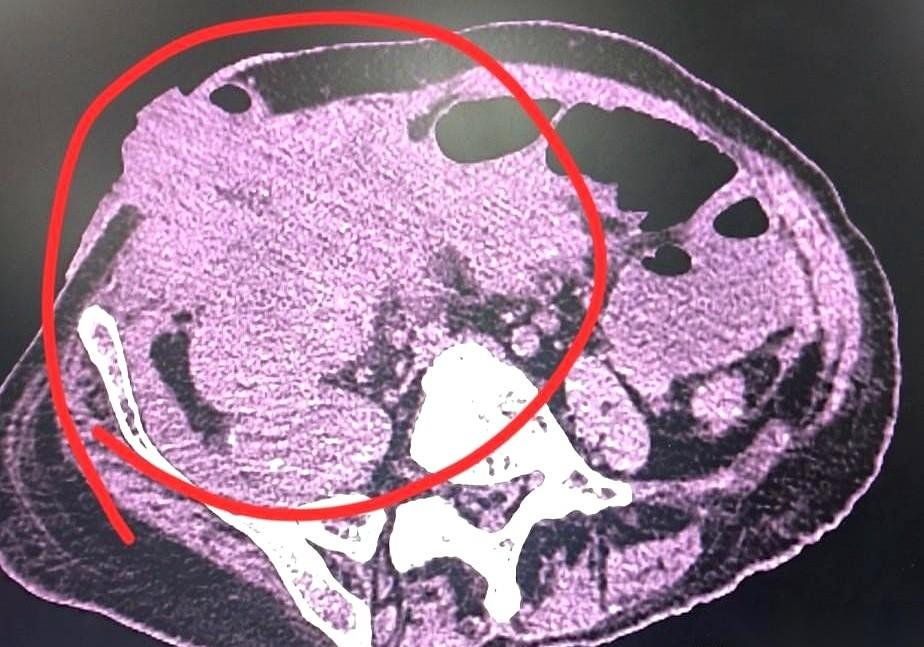 半年，手术白做了。人又送回来了，肚子疼得不行，造的瘘口也堵死了，根本排泄不出来