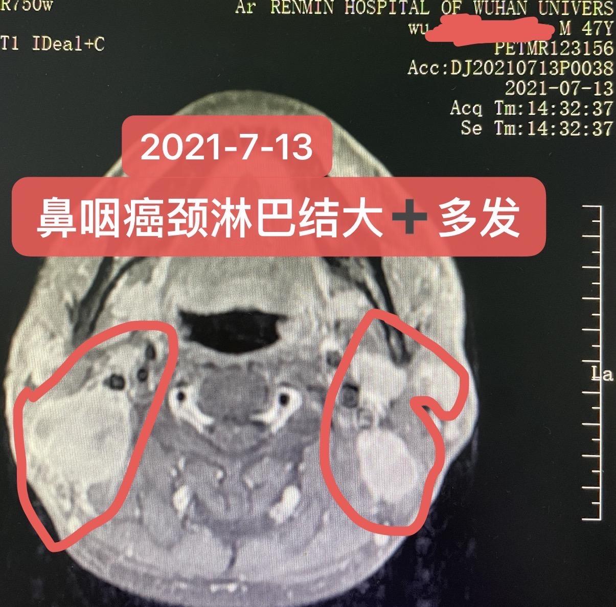 鼻咽癌放化疗后退缩不佳怎么办？局部晚期鼻咽癌，诱导化疗➕免疫，采用GP...