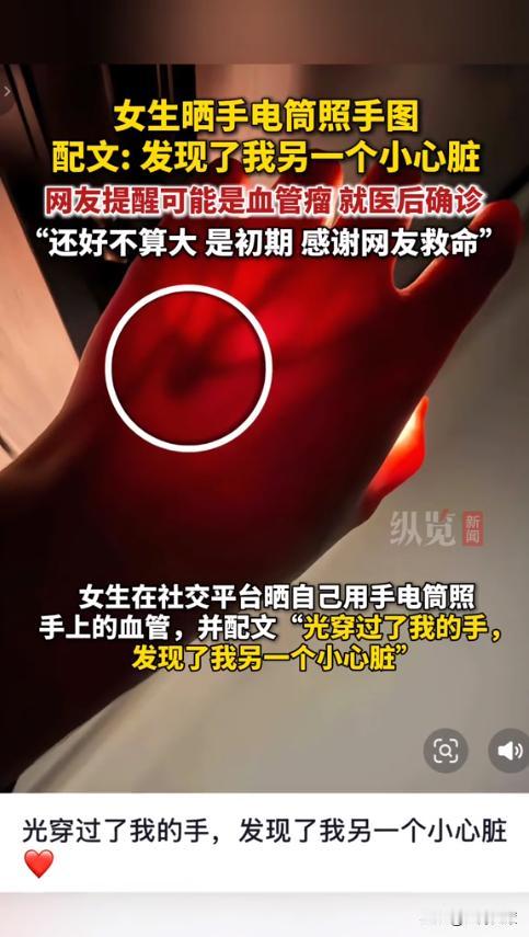 网友们立大功！重庆，一女子在家闲着没事跟风，用手电筒照亮手上的血管，竟意外发现血