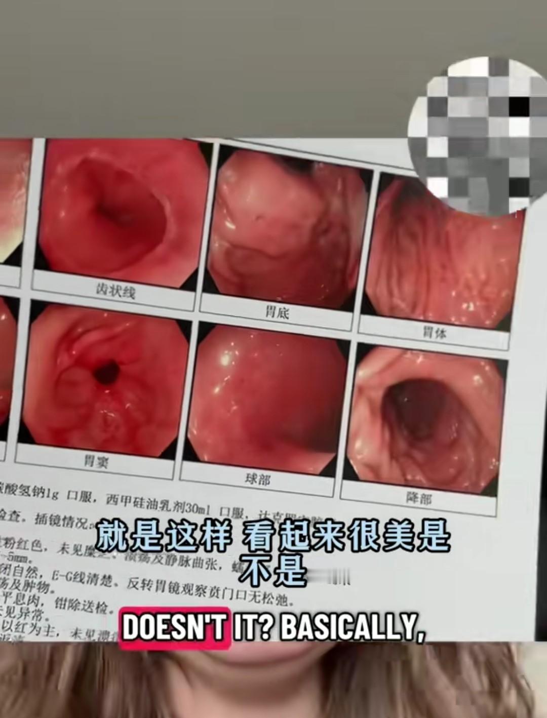 这个来中国看病的博主，她的看病结果出来了。前段时间，有个英国Tiktok博主因