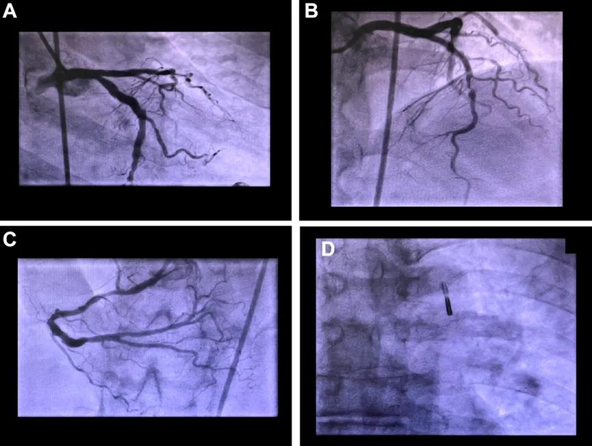 69岁的老张（化名）从未想过，一次看似普通的胸痛会让他直面生死考验。清晨起床后