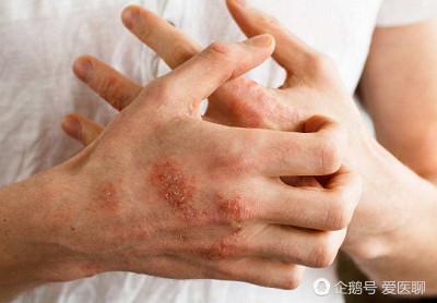 如何区分湿疹和皮肤过敏?