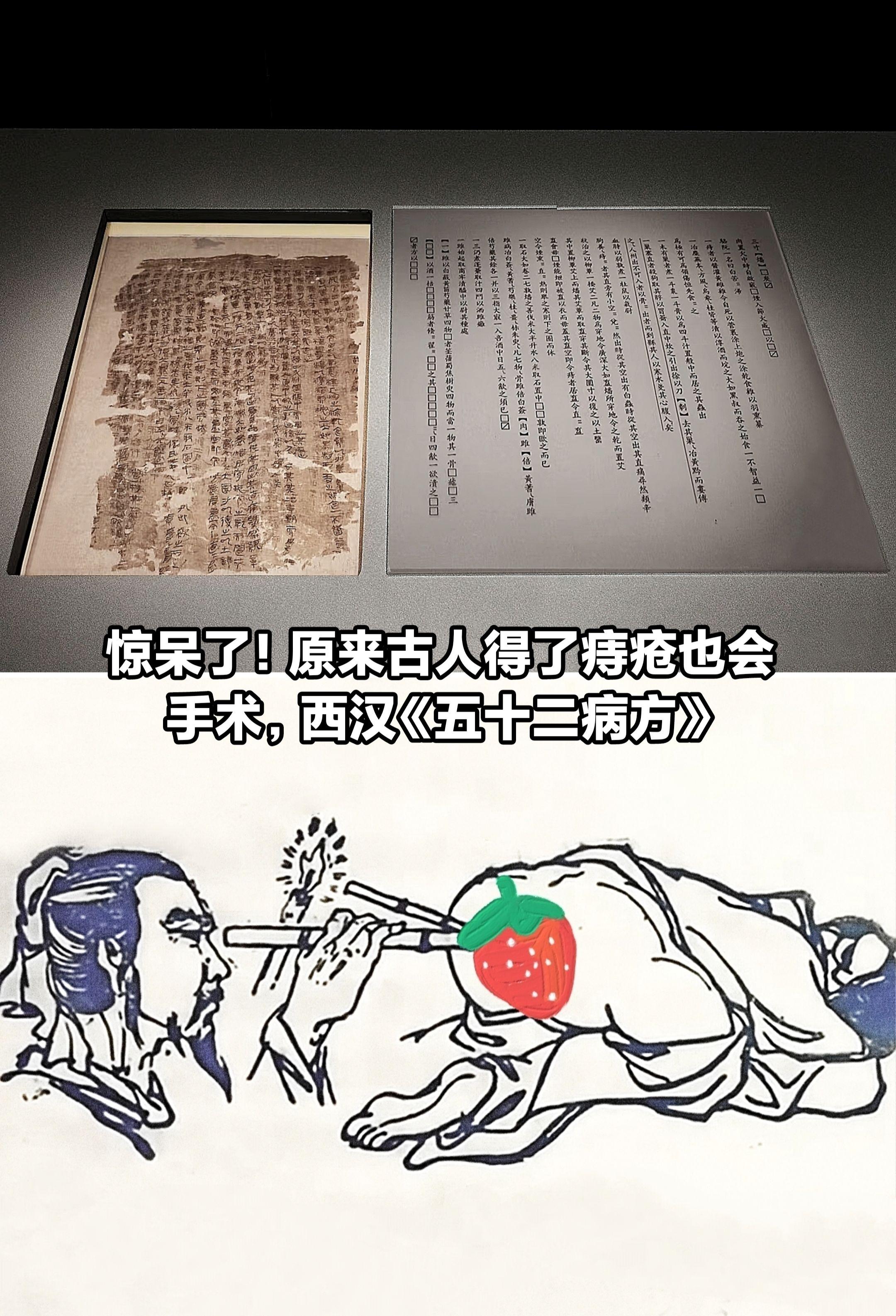 惊呆了，马王堆汉墓出土割痔疮手术帛书。