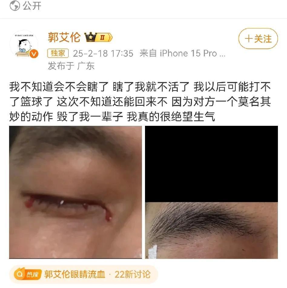 郭艾伦这次真的伤大了！在训练中因为队友的碰撞眼结膜破裂缝了四十多针，郭艾伦说