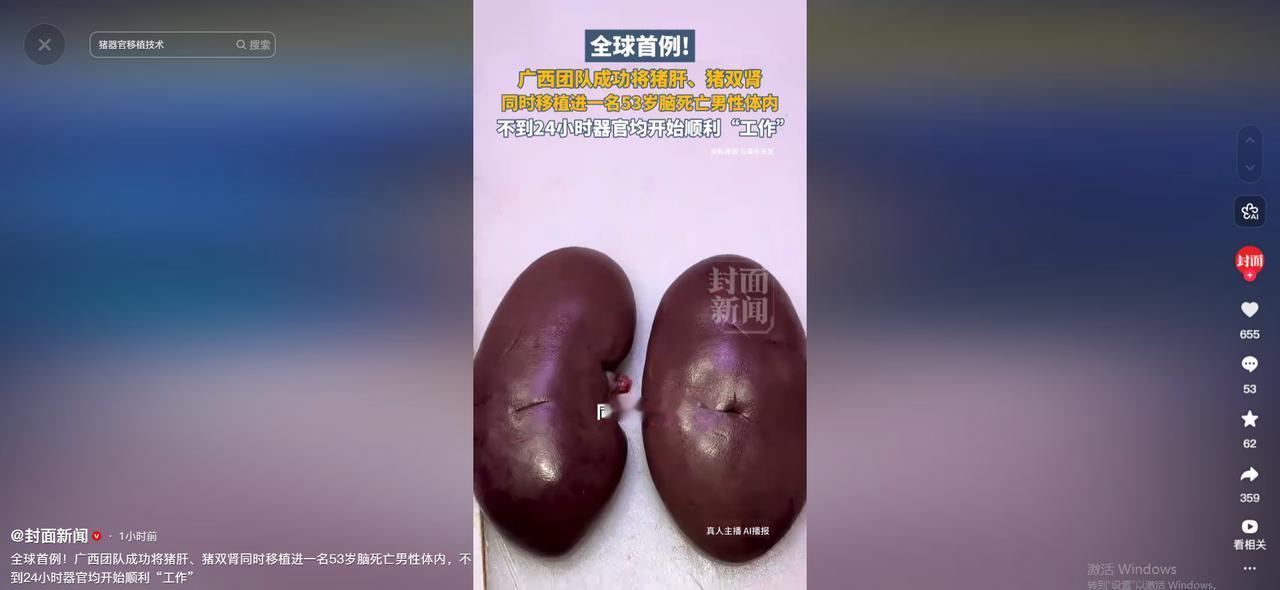 把猪的一个肝脏加上两个肾脏，一次性全部移植到人体内。术后不到二十四小时，这三个器