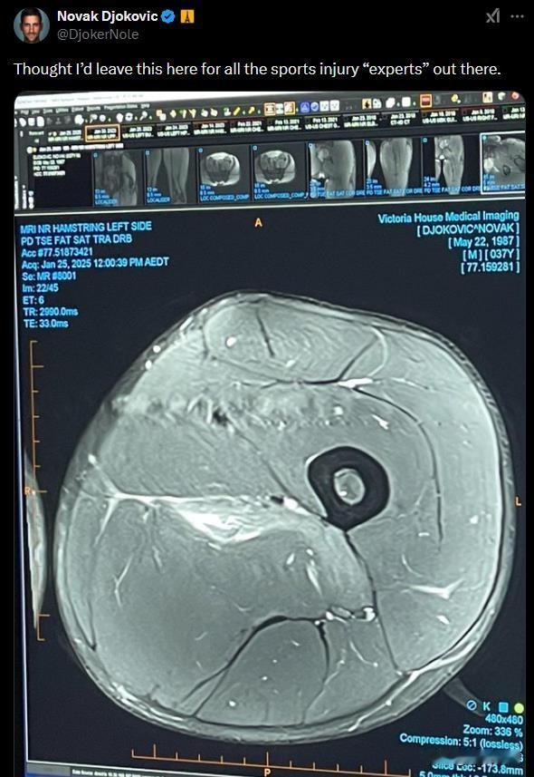 德约科维奇公开了他的CT有没有骨科专家啊，这伤到底重不重啊。恢复需要多久？