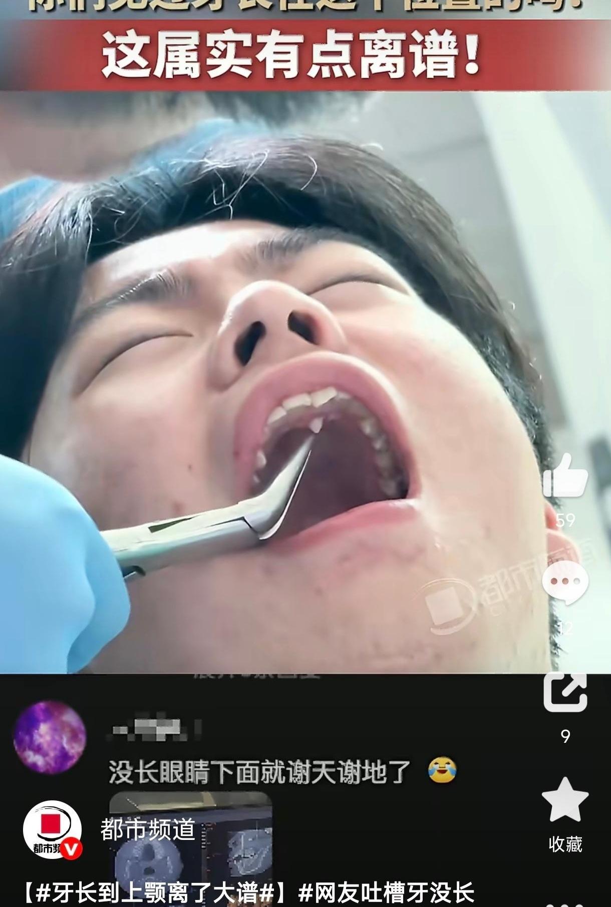 你敢信吗？去拔个牙，医生一撬开嘴，好家伙，里面居然藏着颗“小鲨鱼”！这可不是拍电