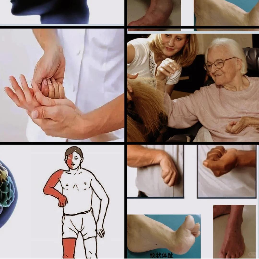 开始供暖了，这是偏瘫/脊髓损伤患者的新挑战！近日北方陆续开始供暖，室内温暖如