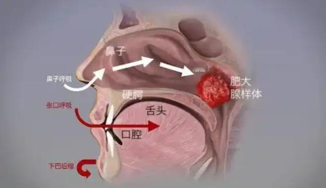 腺样体肥大、长不高、易生病？试试这个用了30年的‘消腺方’，3个月改善体质、腺样