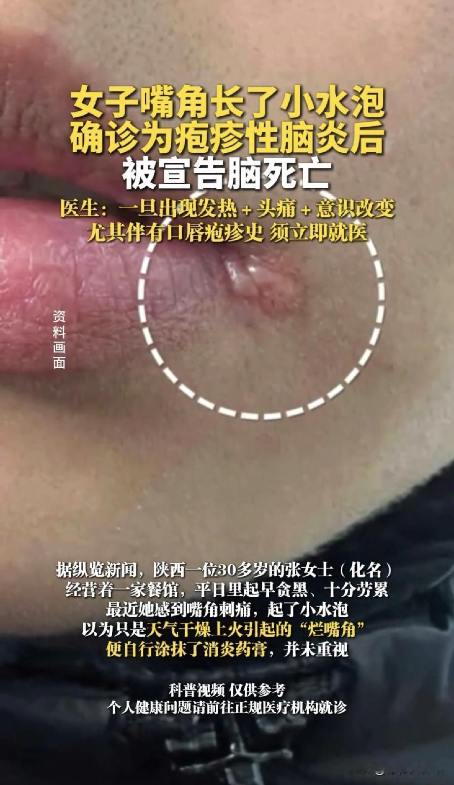谁能想到，嘴角一个小水泡，竟让30岁妈妈脑死亡…真的不敢信啊家人们！陕西一