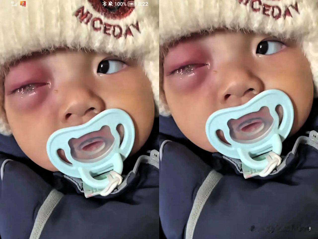 天塌了！宝宝一次摔倒，磕到了眼睛，爸妈没在意。儿子眼睛状况愈发严重，最终失明。爸