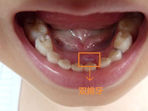 换牙期孩子“双排牙”! 只怪家长没做好这些