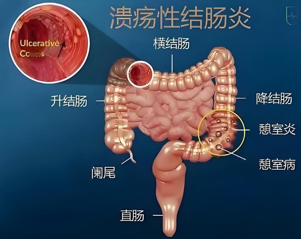 溃疡性结肠炎，腹痛便血反复发作3年，2个月症状消失肠道恢复健康56岁女溃疡