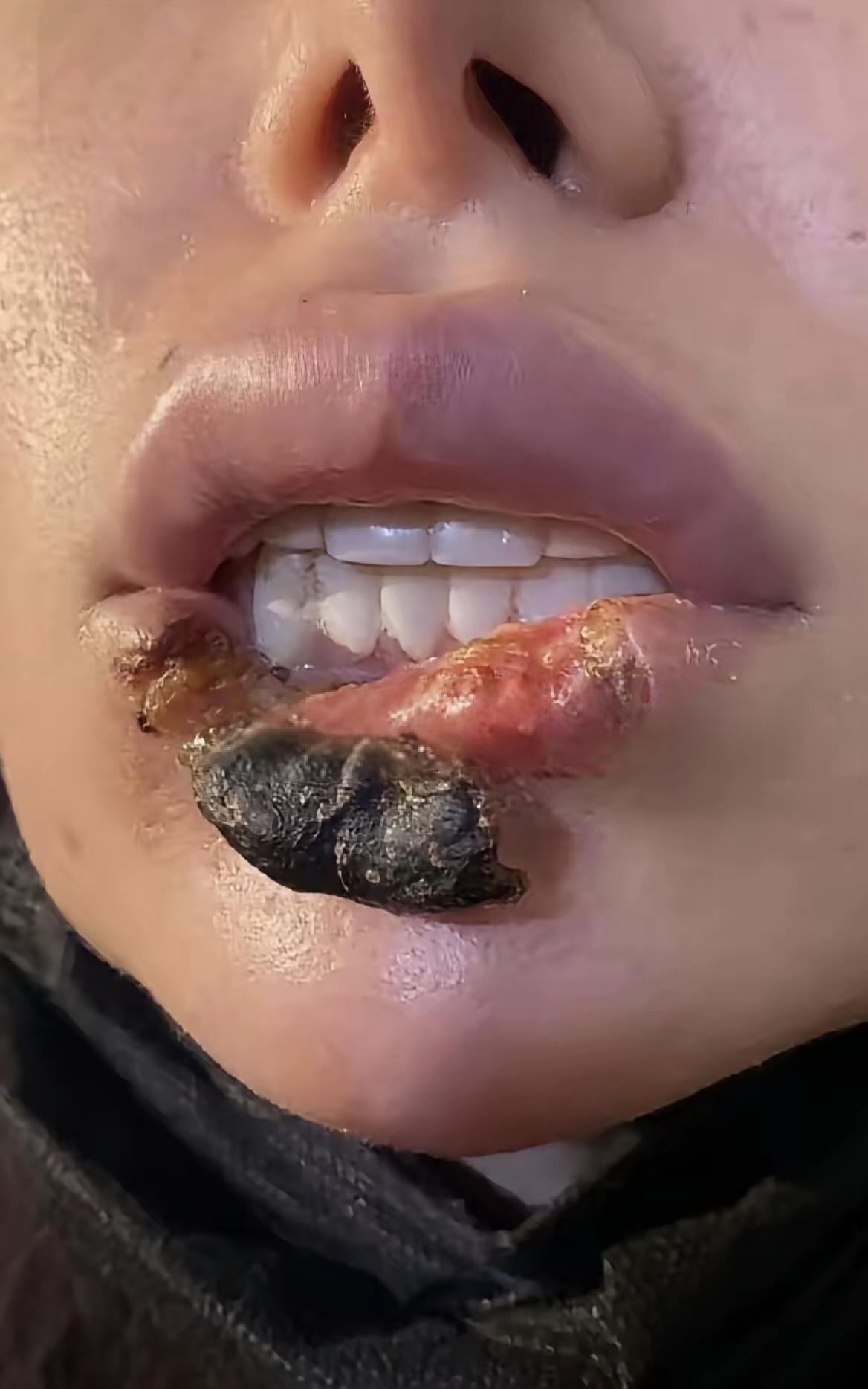这就是想美的另一种可能，真的看得心里一揪。一个女孩只是想微调变好看，打玻尿酸
