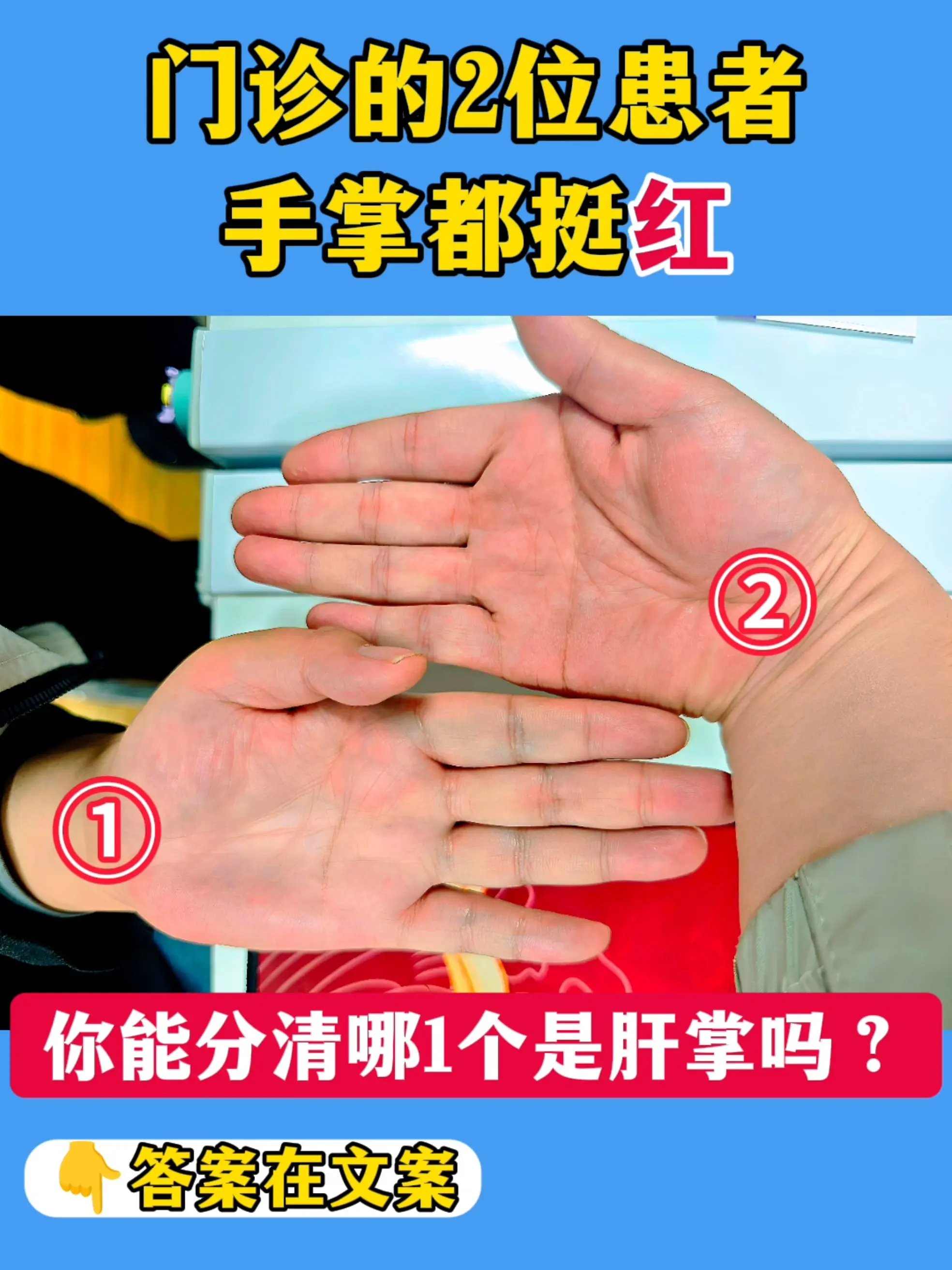 门诊连着遇到 2 位患者，一个是肝硬化患者，另一个则是脂肪肝的，手掌看...