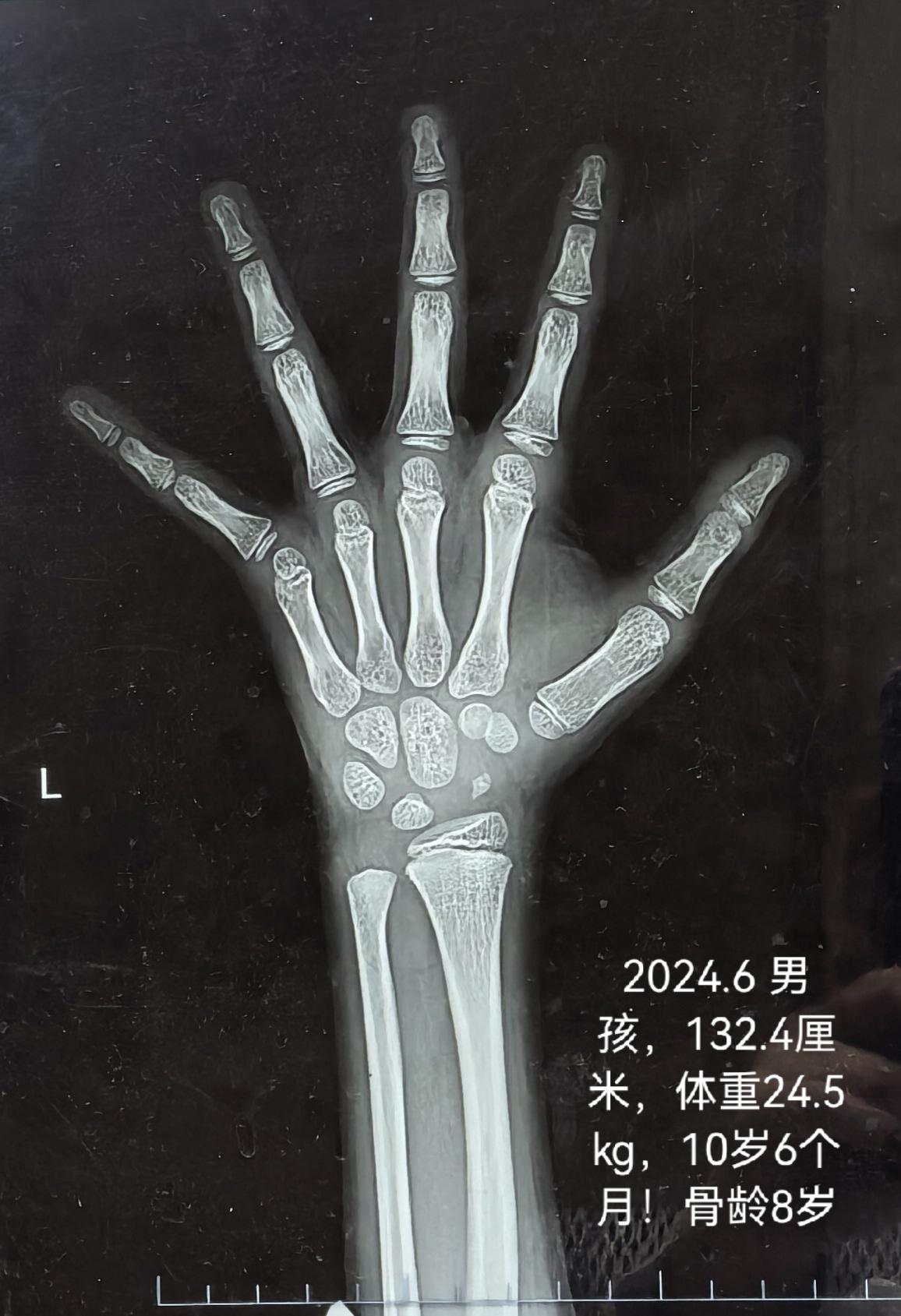 男孩12岁4个月，身高143厘米，没有青春期发育迹象，因为身高远低于同龄人，家长