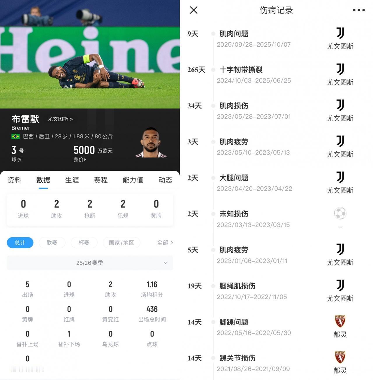 尤文的天塌了！布雷默左膝半月板部分切除，基本宣告玻璃人了，尤文亏大了。布雷默是