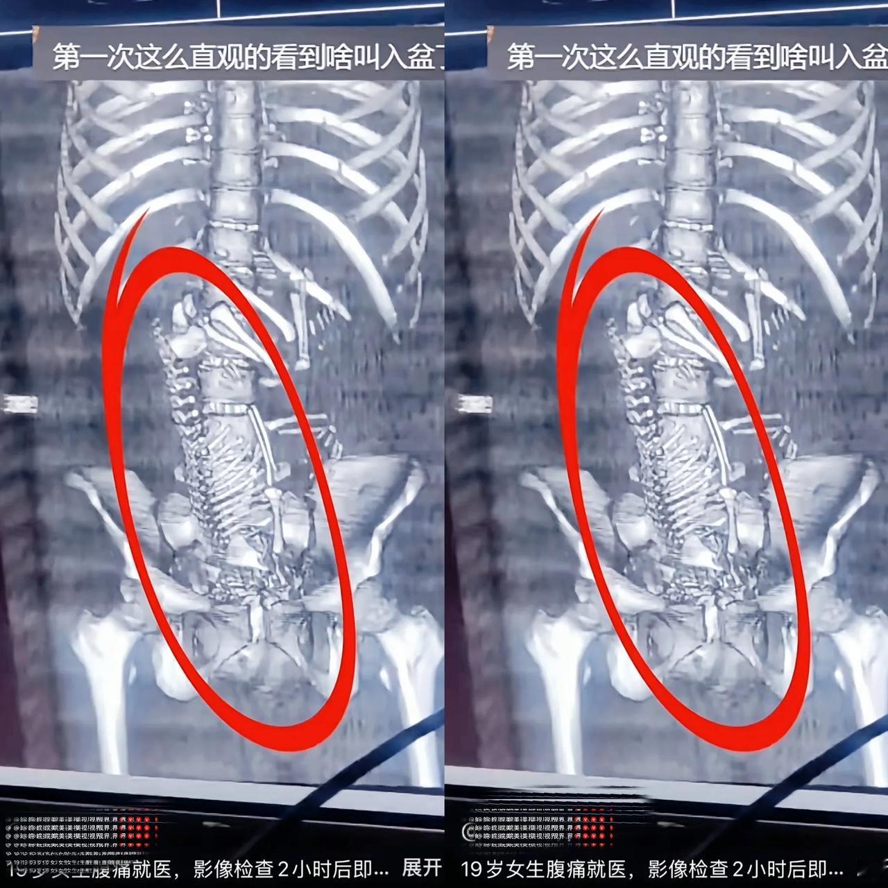 19岁女生腹痛就医，医生反复问是不是怀孕都被否认，结果影像一照，胎儿骨骼清清楚楚