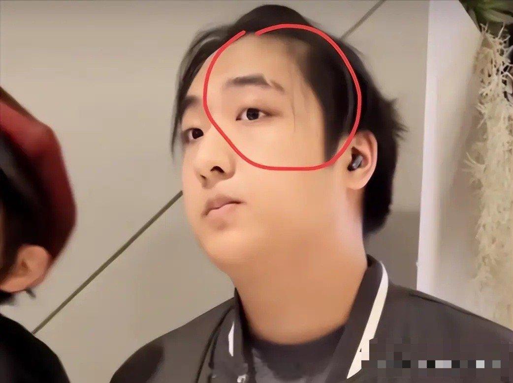 看到费曼脸上巨大的伤疤，才终于知道当年吴镇宇怒摔话筒真算轻的了​​​