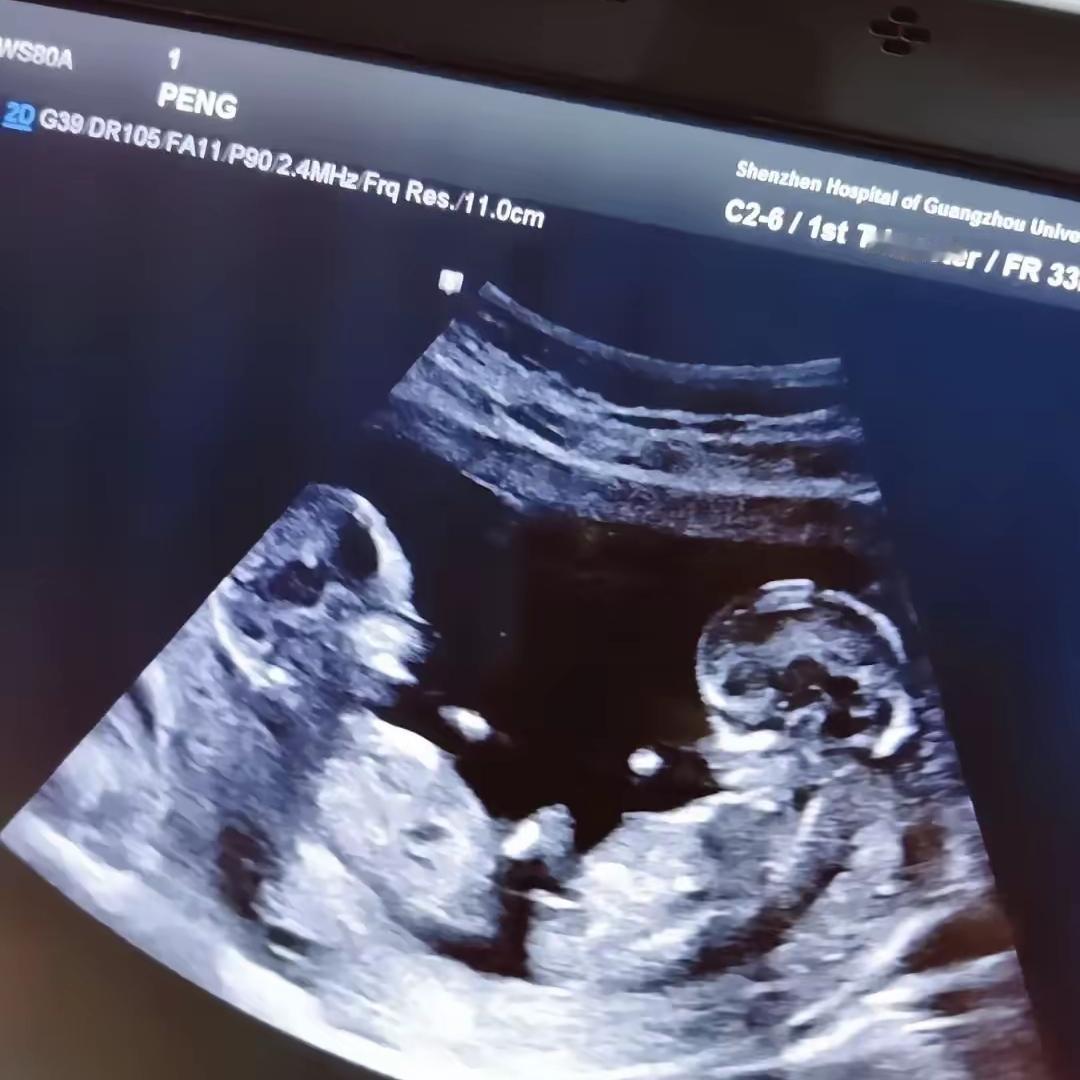 谁能想到啊，怀孕八个月居然还能被命运送一份“惊喜大礼”！湖北这位孕妈本来只是胎动