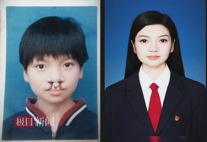 唇腭裂患者直播8小时声援嫣然医院 李亚鹏暖心互动回应