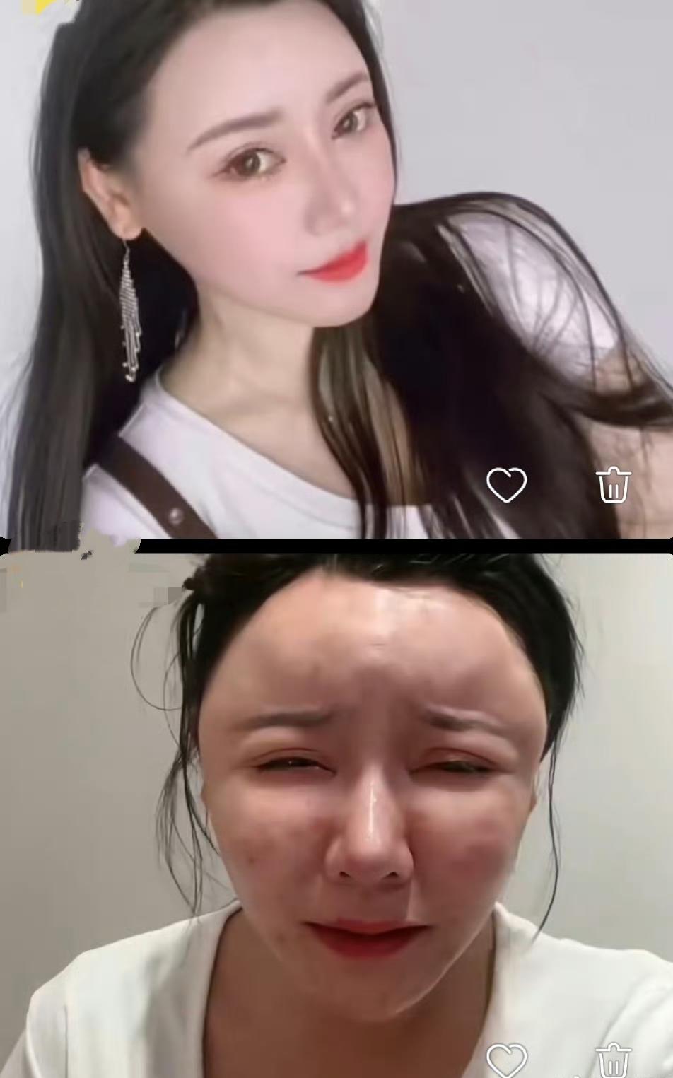 最近，一位女子因过度医美导致面部“馒化”的视频在网络上疯传。视频里的她，脸肿得像